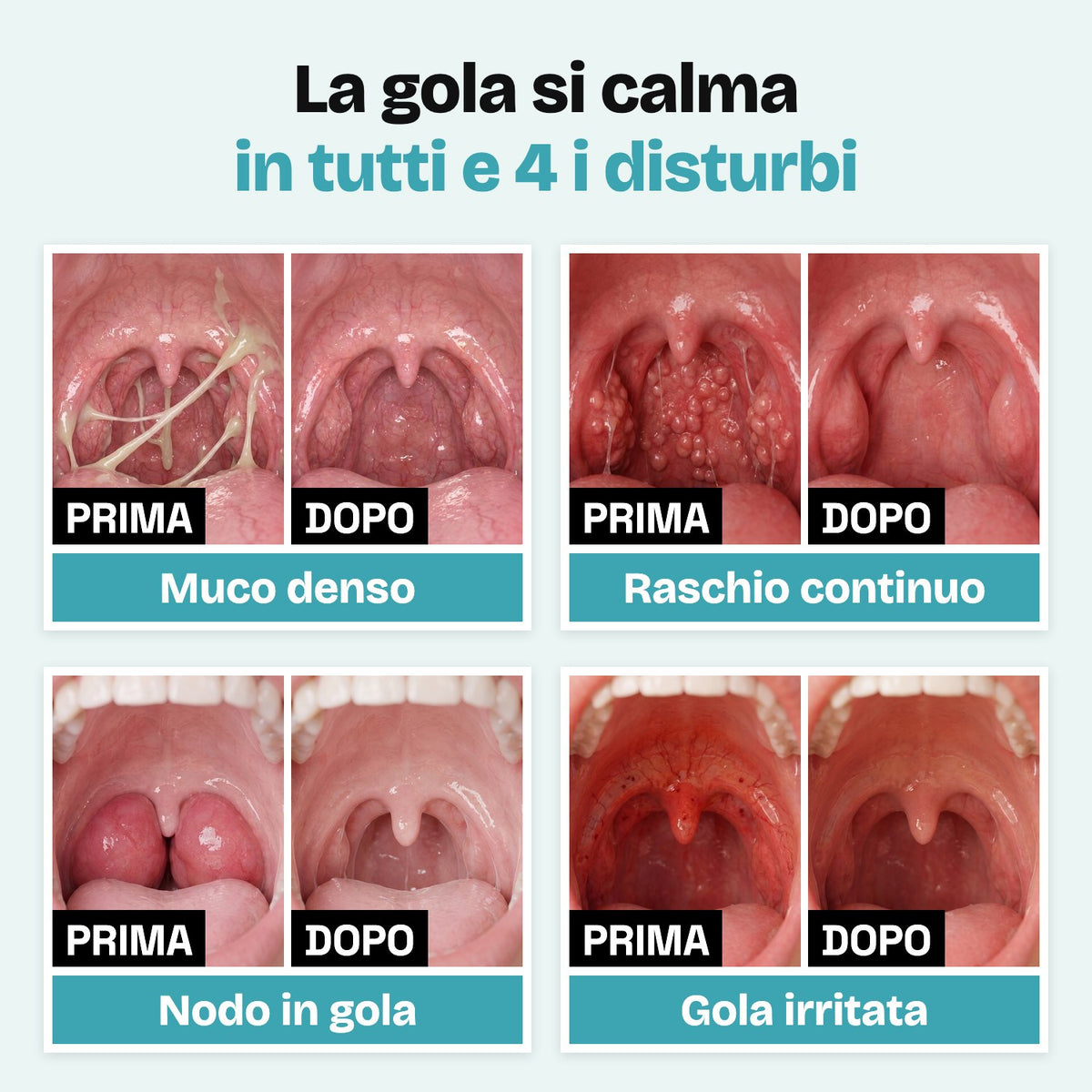 La gola si calma in tutti e 4 i disturbi: prima e dopo