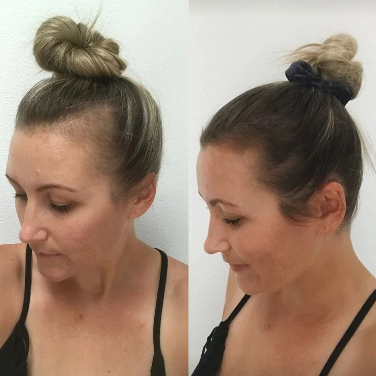 Sichtbar dichteres Haar in den lichten Stellen