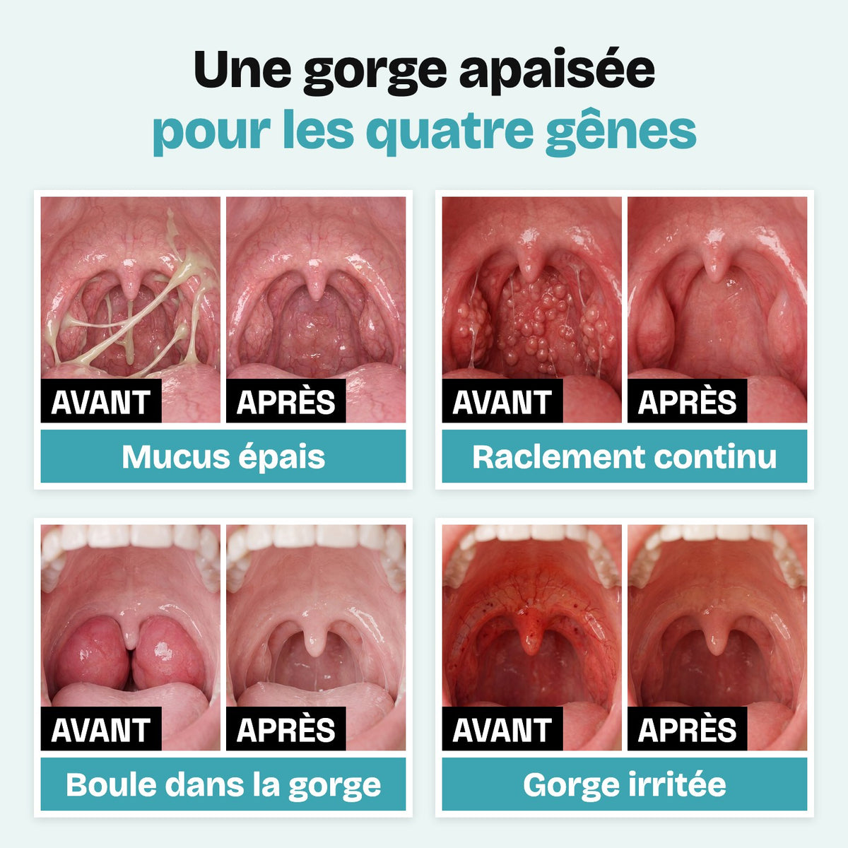 Une gorge apaisée pour les quatre gênes : avant et après